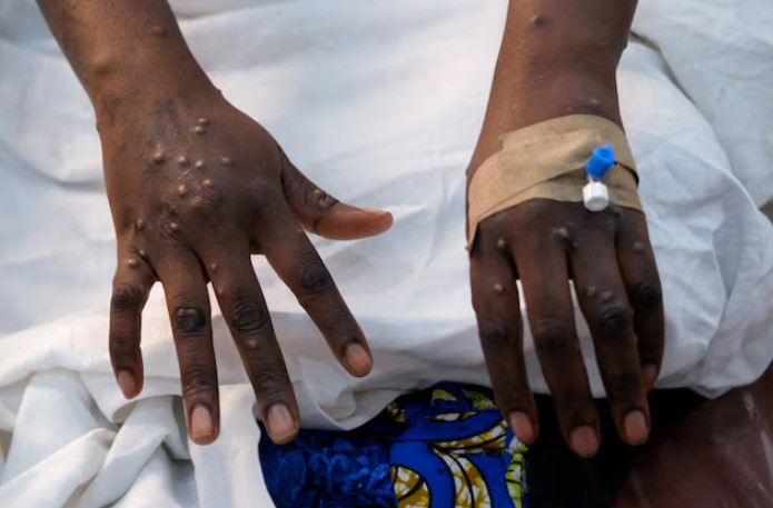 Mpox continues to spread in Africa, with 18 countries reporting active transmission